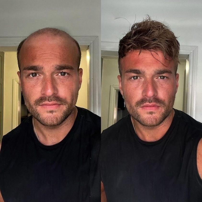 Sistema Di Sostuzione Dei Capelli Con Parrucchino Da Uomo Pelle - Foto 5