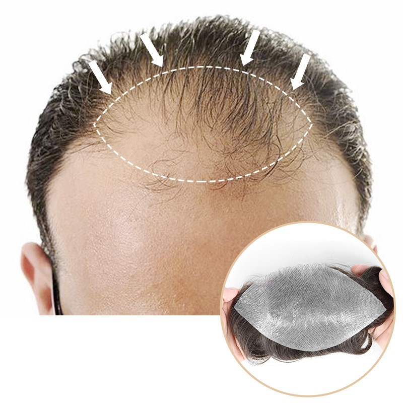 Vikende hårfeste-patch | Dekker vikende hårfeste og toppen av hodet