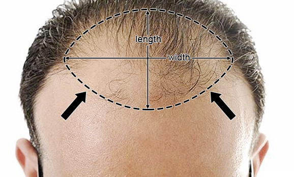 Hairline Patch - product view