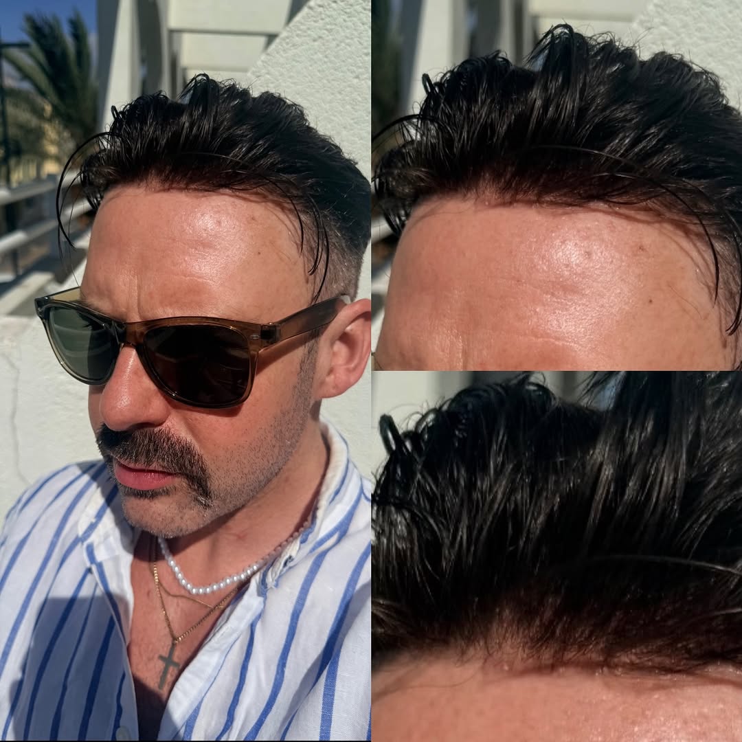 0.04–0.06mm V-Loop Thin Skin Men's Hair System | 8x10 | Antimicrobial Base — base construction detail