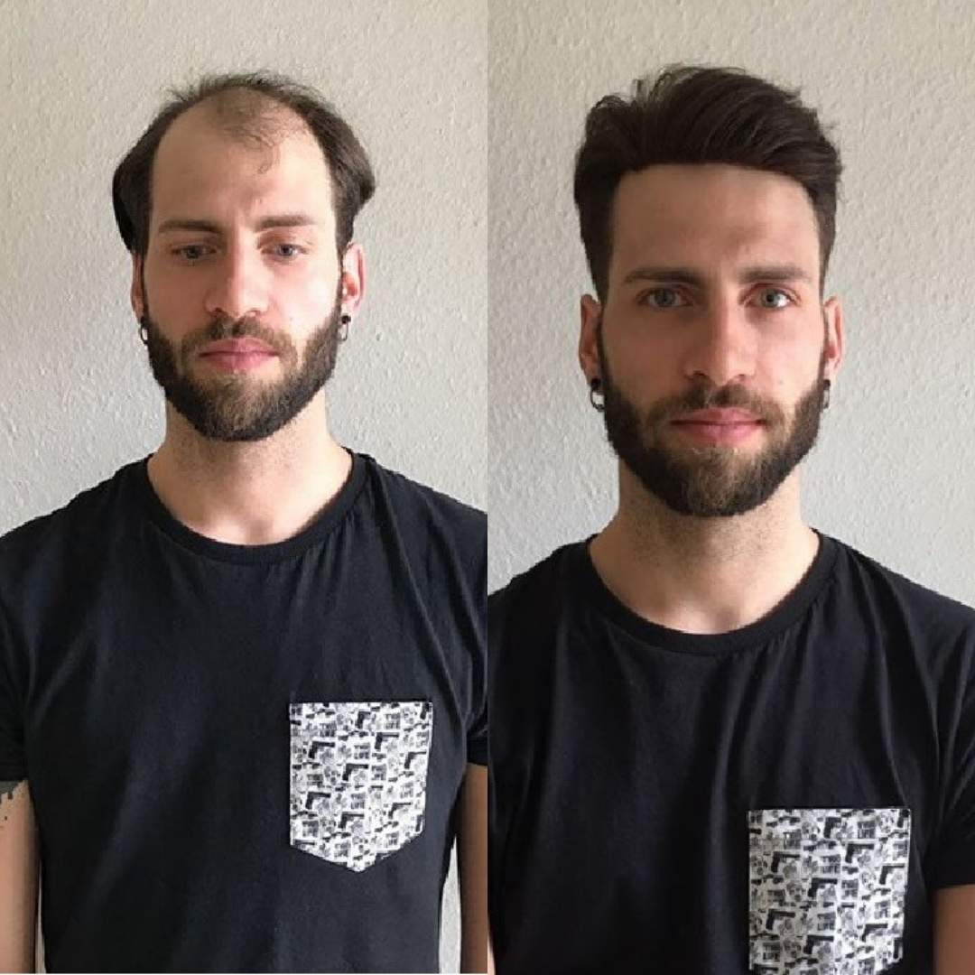 0.10-0.12mm Full Skin Base Men's Hairpieces - product view
