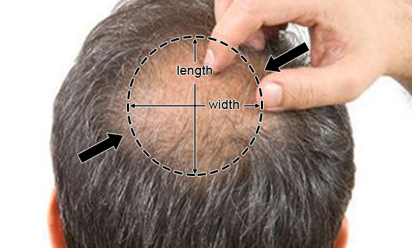 Crown Hair Patch - product view