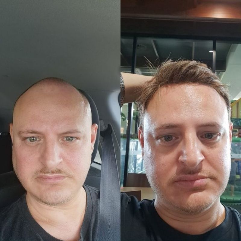 hair system before after