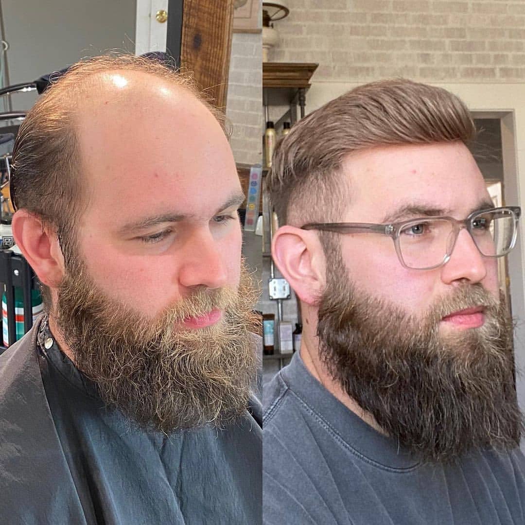 Punertava sävy 0,02-0,03 mm täysi poly ohut iho hiusjärjestelmät miehille | Poly-ihotoupee