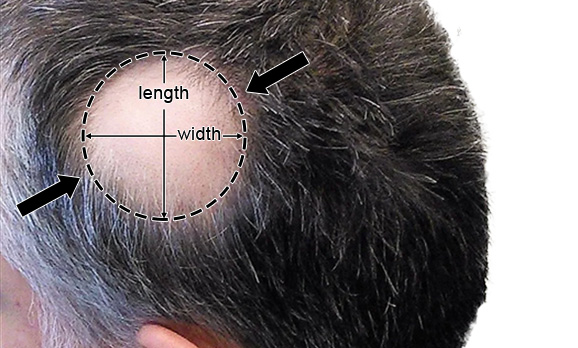 Side/Back Hair Patches for Men - product view