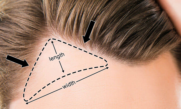 Temple Hair Patches for Men & Women - product view