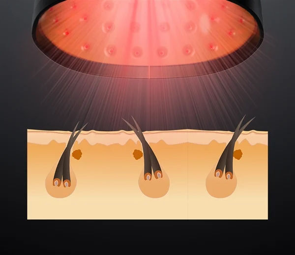 ReHair® Laser Haargroeipet | Laserpet tegen haaruitval