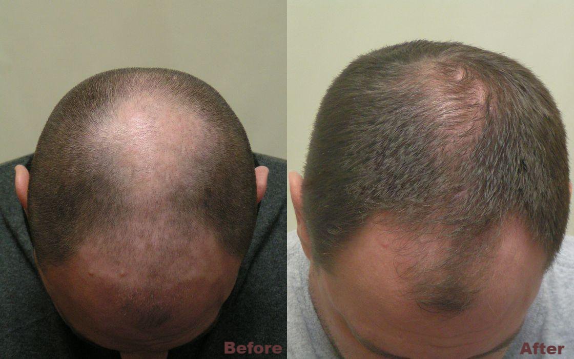 laser hair regrowth before and after